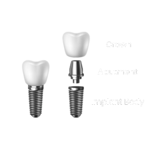 Close-up image of an abutment, which connects the dental implant crown to the implant body.