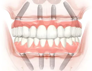 Full arch replacement using 4-6 dental implants.