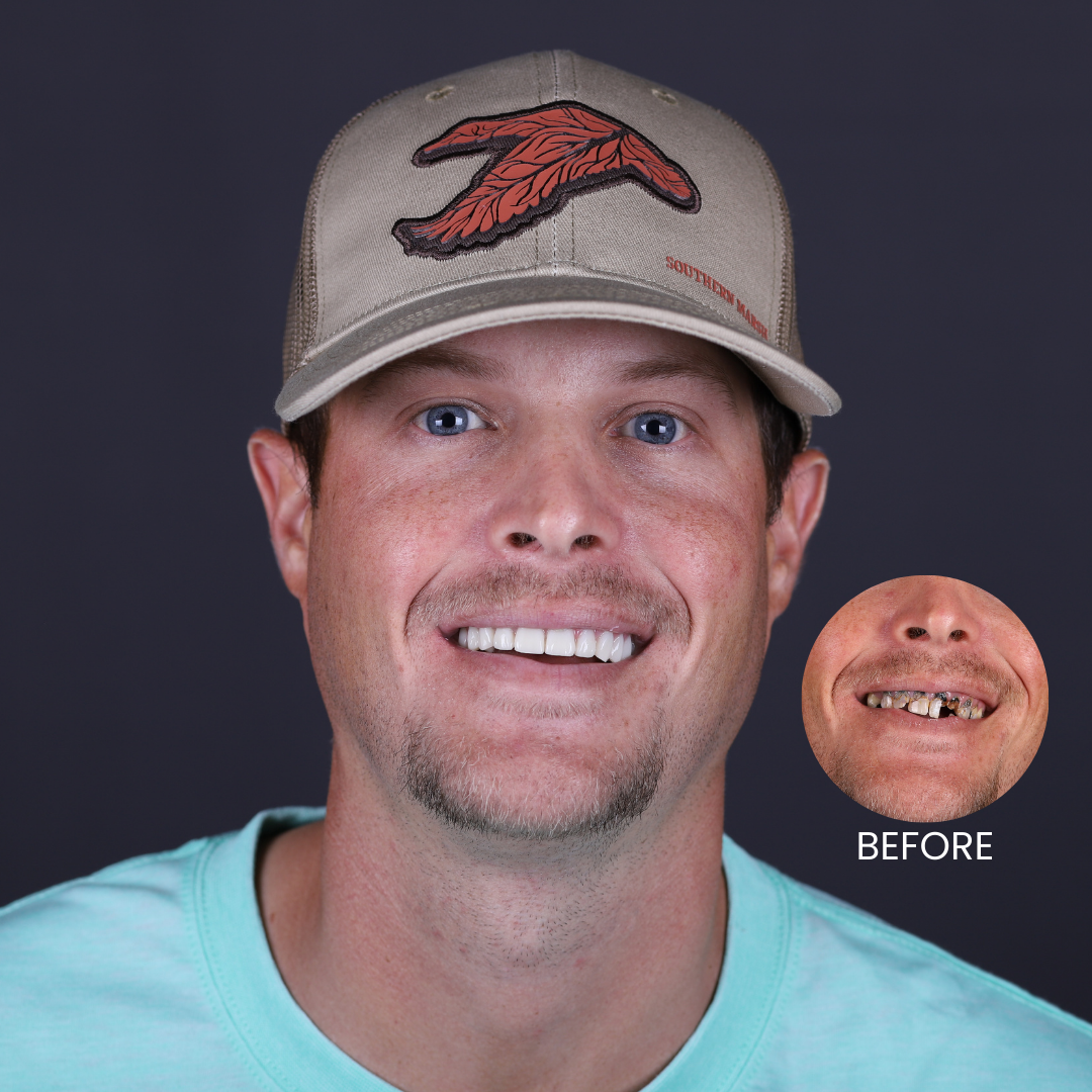 A white male patient smiling with a before picture of his full mouth dental implants