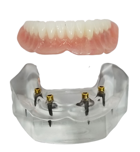 Snap-in locator for implant dentures demonstrating the attachment mechanism.