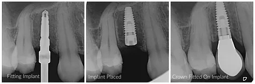 Illustration of an implant body, the titanium screw placed in the jawbone, acting as an anchor for the dental implant.
