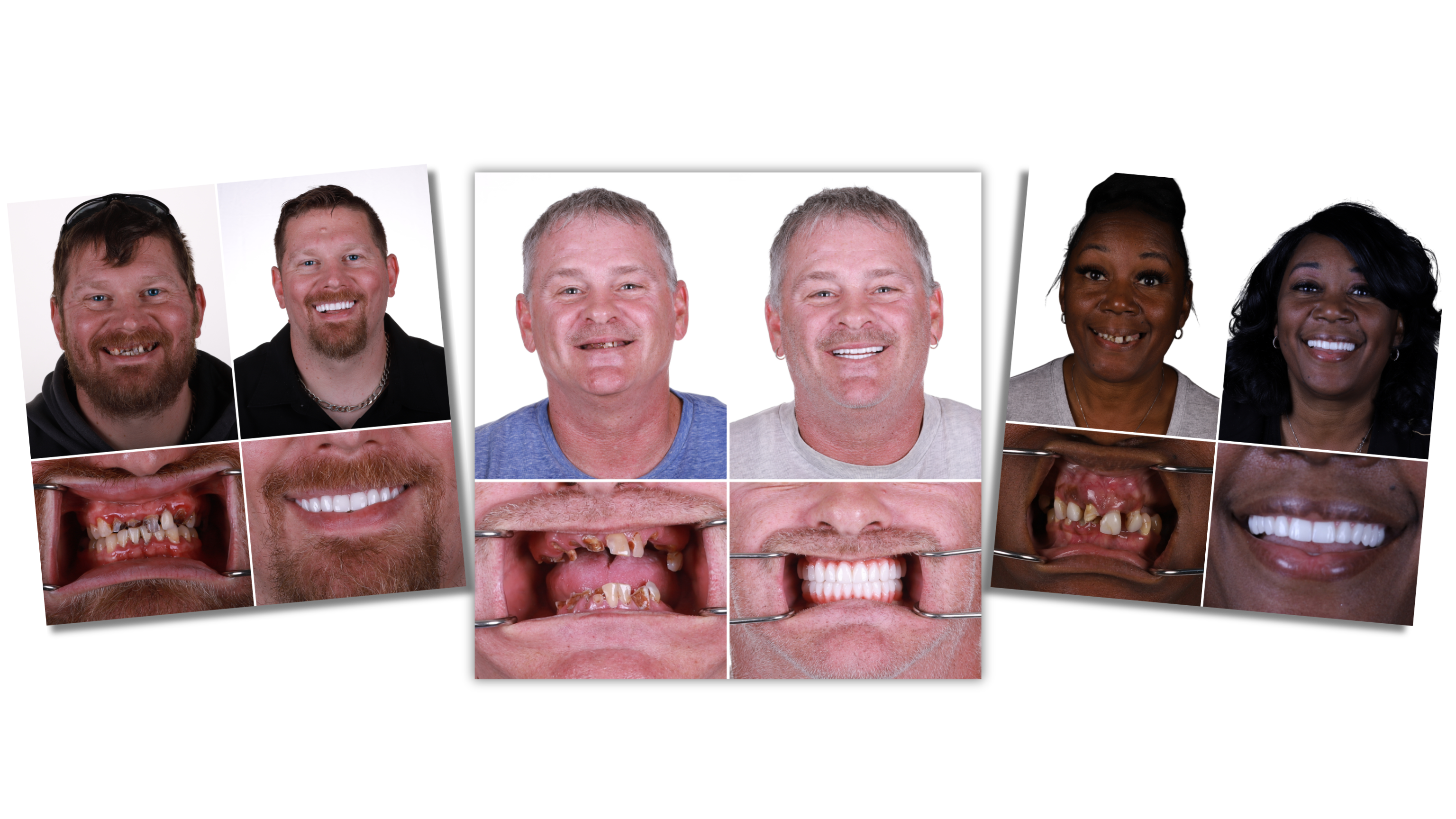 Smile transformations from numerous patients for full mouth dental implants
