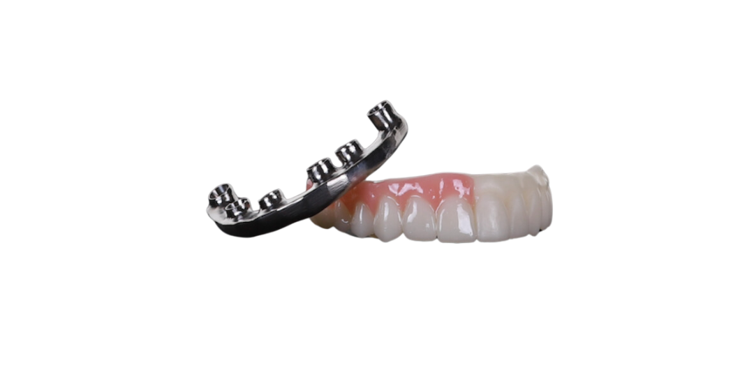 Dental implant arch with a titanium bar.