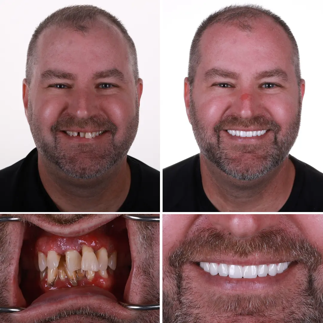 Before and after dental implants of a male patient at Restore in 24.