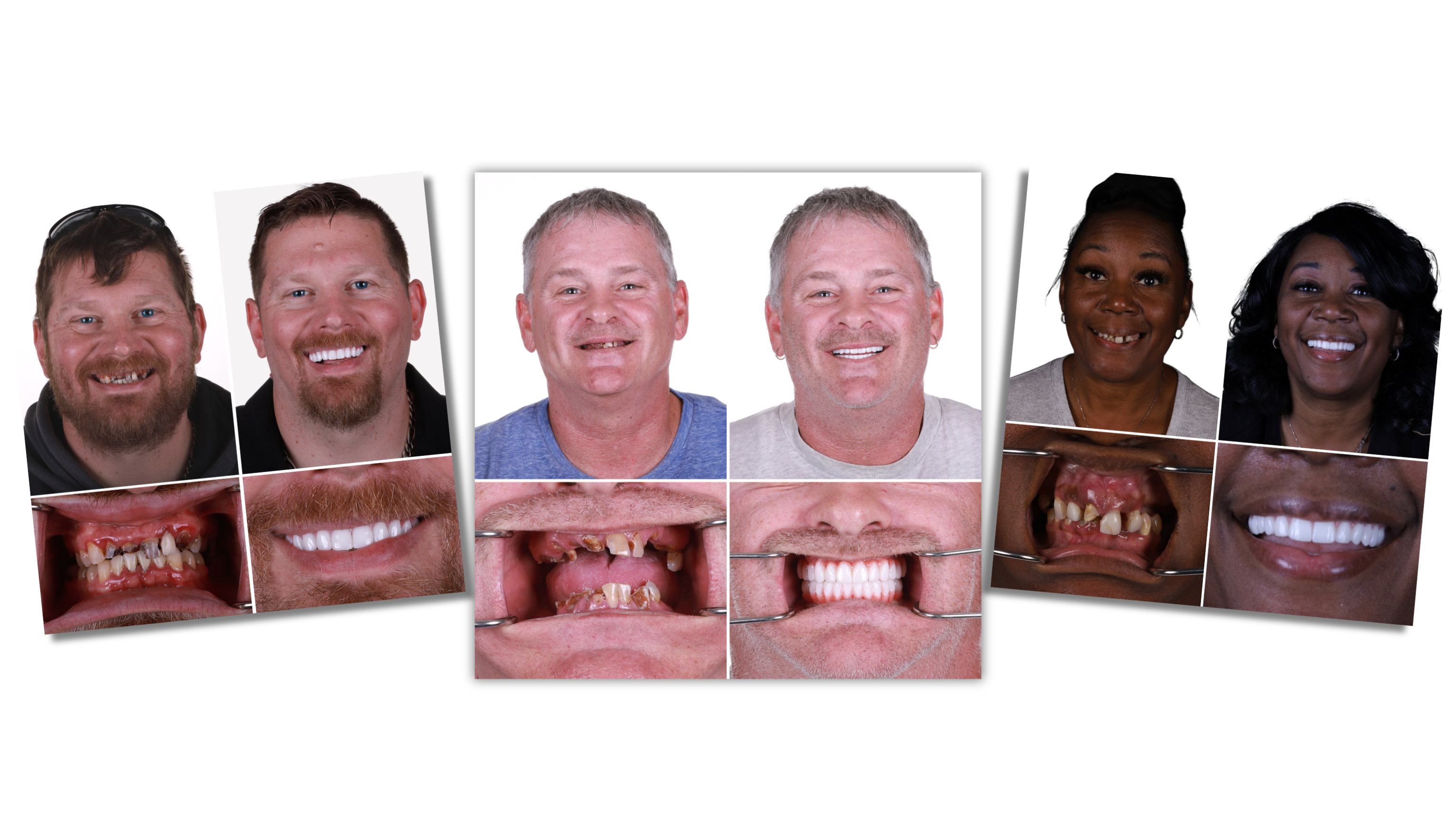 Before and after photos of dental implant patients