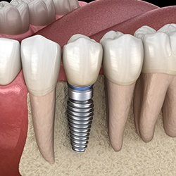Illustration of a single dental implant with a crown in place among natural teeth.