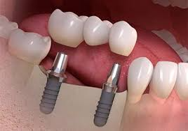 Illustration of an implant bridge procedure with two dental implants supporting a row of three crowns.