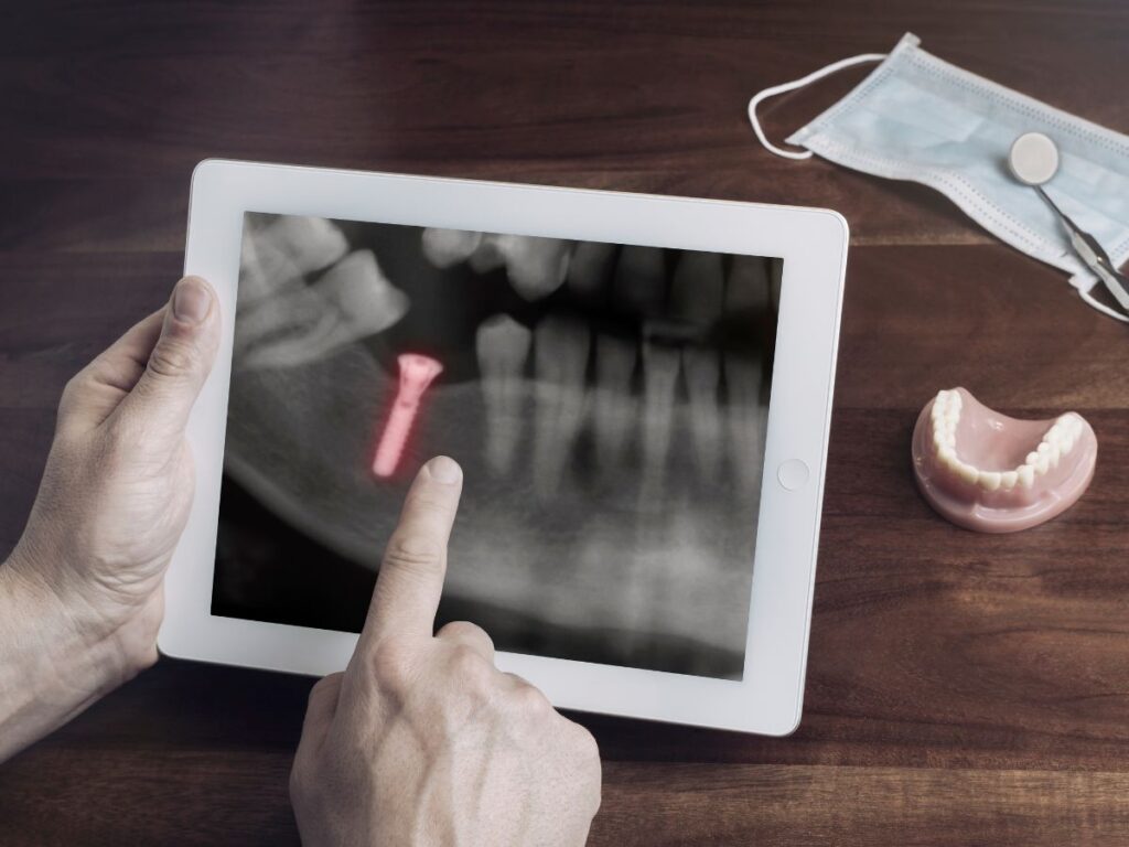 xray showing dental implant as artificial tooth root