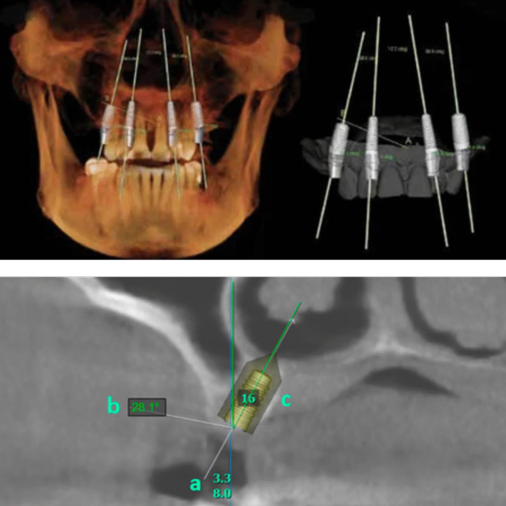 3D Imaging for full mouth dental implants