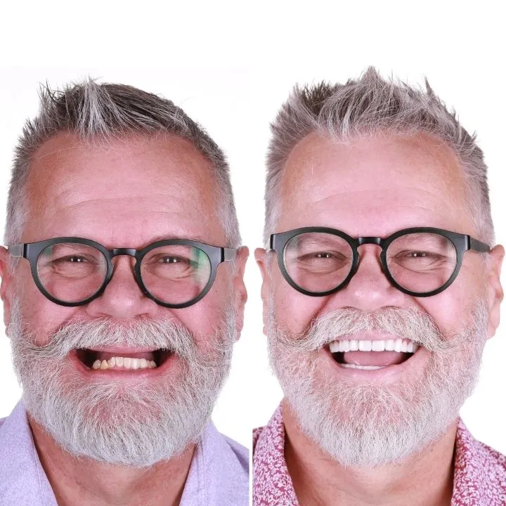 Before and after of a man smiling after getting full mouth dental implants