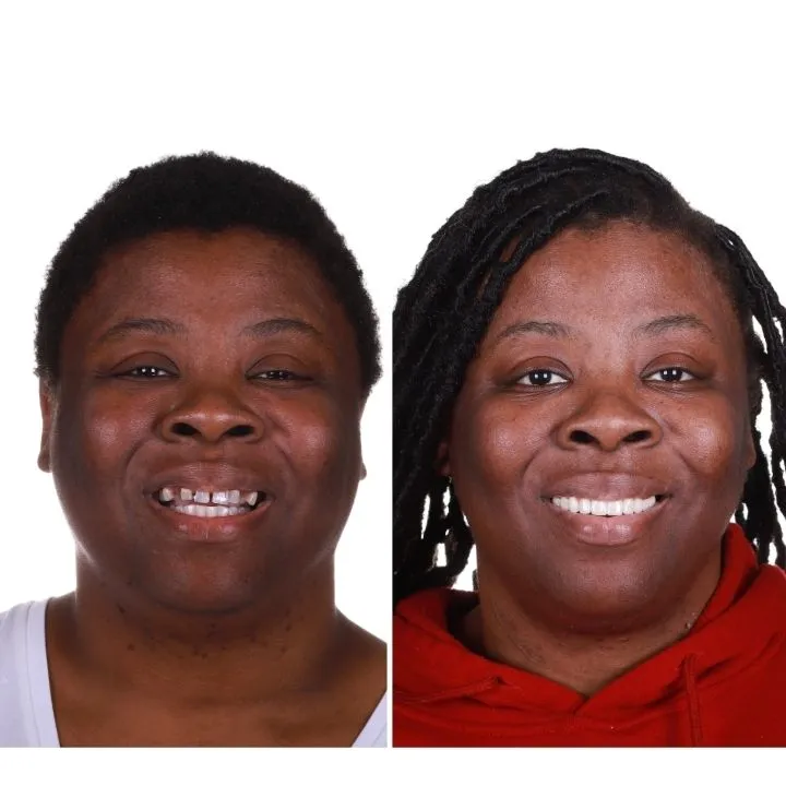 Patient smile after FP3 dental implant restoration at Restore in 24