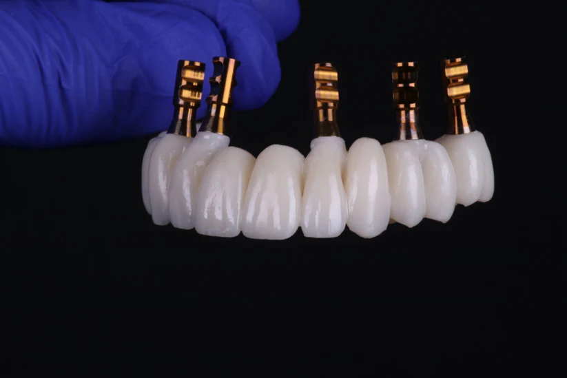 fp1, fp2, anf fp3 implants