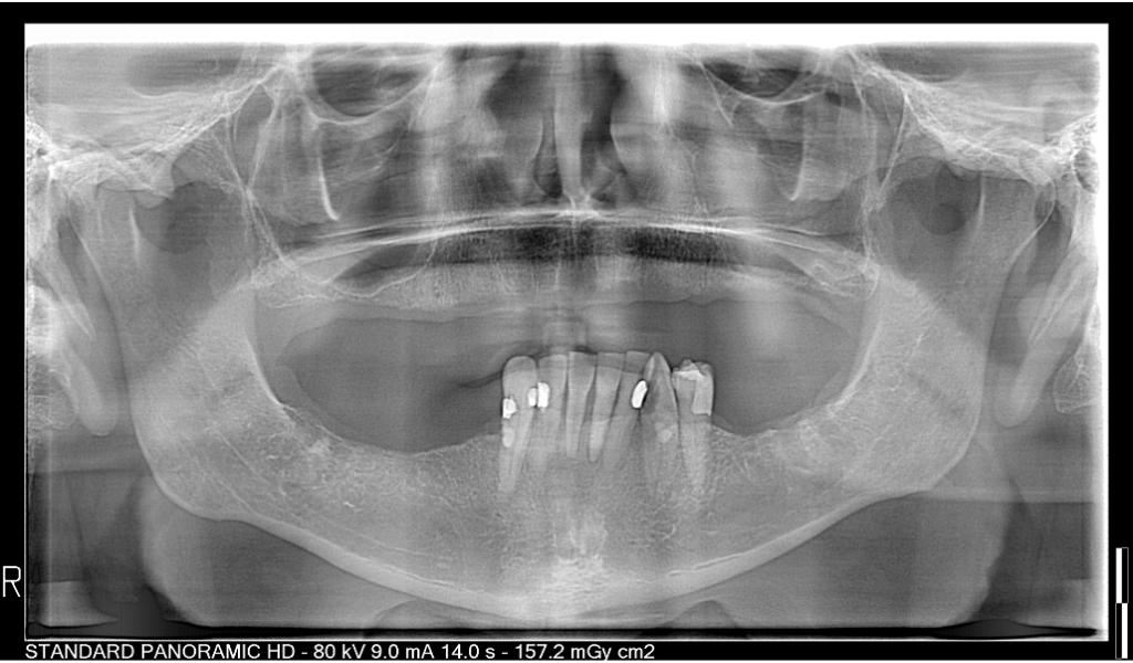 pano xray bone loss