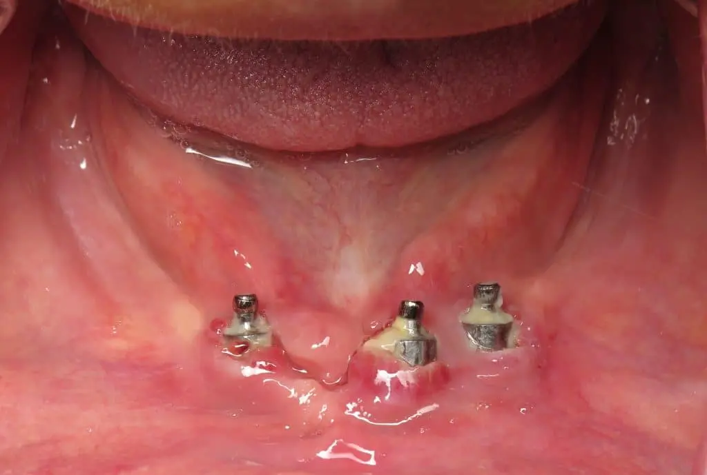 dental implant plaque build up and gums irritation