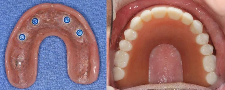 implant denture without palatal coverage