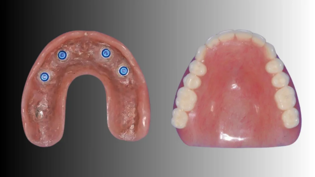 traditional full palate denture vs implant denture no palate